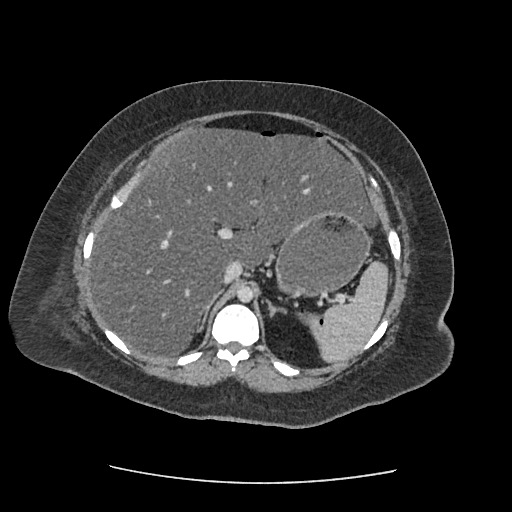Bowel and splenic infarcts in acute lymphocytic leukemia (Radiopaedia 61055-68915 A 43).jpg