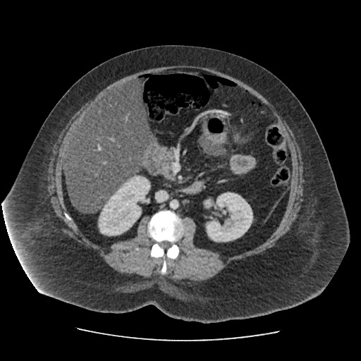 Bowel and splenic infarcts in acute lymphocytic leukemia (Radiopaedia 61055-68915 A 63).jpg