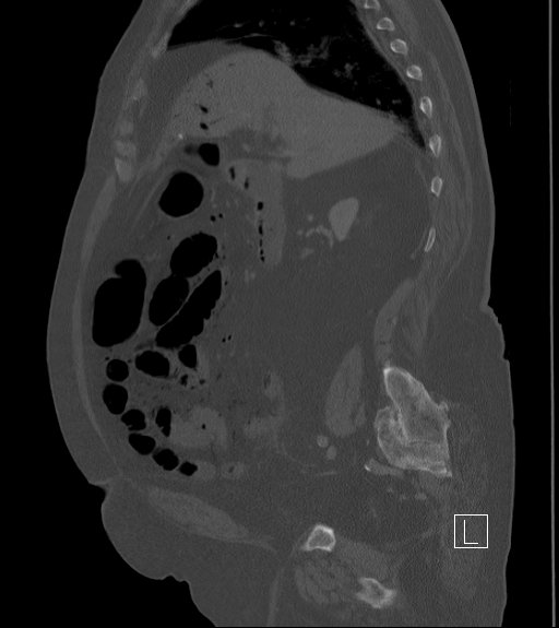 Bowel ischemia secondary to SMA occlusion with extensive portomesenteric venous gas (Radiopaedia 54656-60871 Sagittal bone window 72).jpg