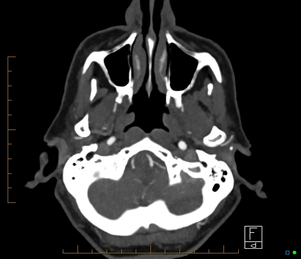 Brachiocephalic trunk stenosis (Radiopaedia 87242-103519 A 61).jpg
