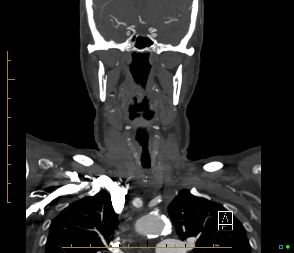 Brachiocephalic trunk stenosis (Radiopaedia 87242-103519 B 31).jpg