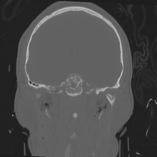 Brain contusions, internal carotid artery dissection and base of skull fracture (Radiopaedia 34089-35339 Coronal bone window 37).png