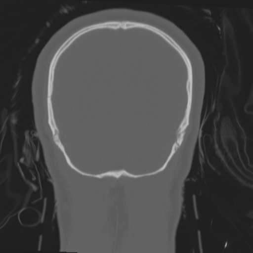 File:Brain contusions, internal carotid artery dissection and base of skull fracture (Radiopaedia 34089-35339 Coronal bone window 57).png