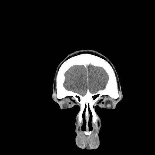 Brain death (Radiopaedia 78597-91360 Coronal non-contrast 9).jpg