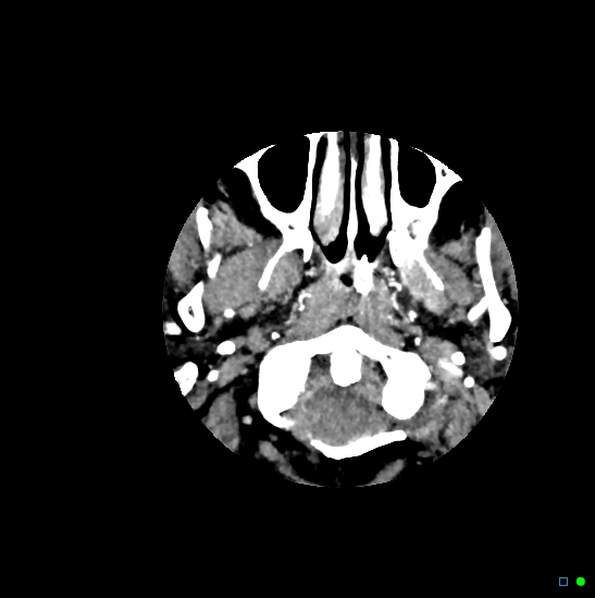 Brain death on MRI and CT angiography (Radiopaedia 42560-45841 B 51).jpg