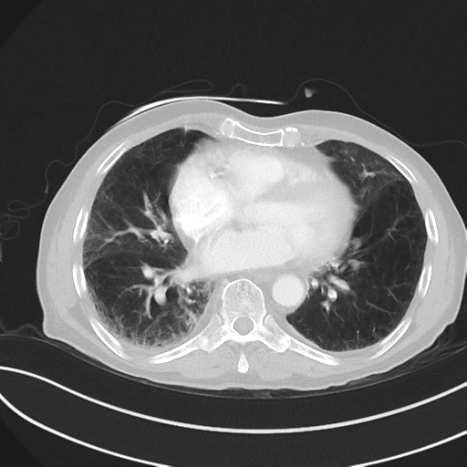 File:Brain metastasis (lung cancer) (Radiopaedia 48289-53180 Axial lung window 39).png
