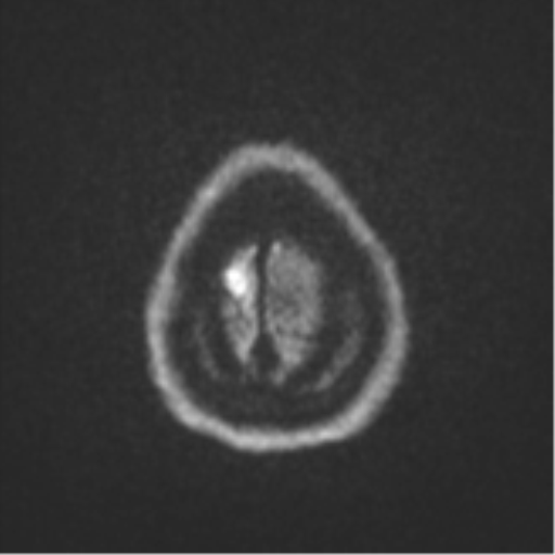 Brain metastasis (sarcoma) (Radiopaedia 47576-52209 Axial DWI 54).png