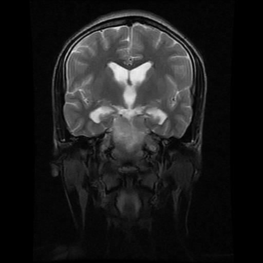 File:Brainstem glioma (Radiopaedia 30923-31624 Coronal T2 11).jpg
