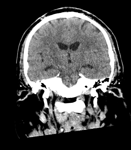 Brainstem hemorrhage (Radiopaedia 81294-94976 Coronal non-contrast 36).jpg