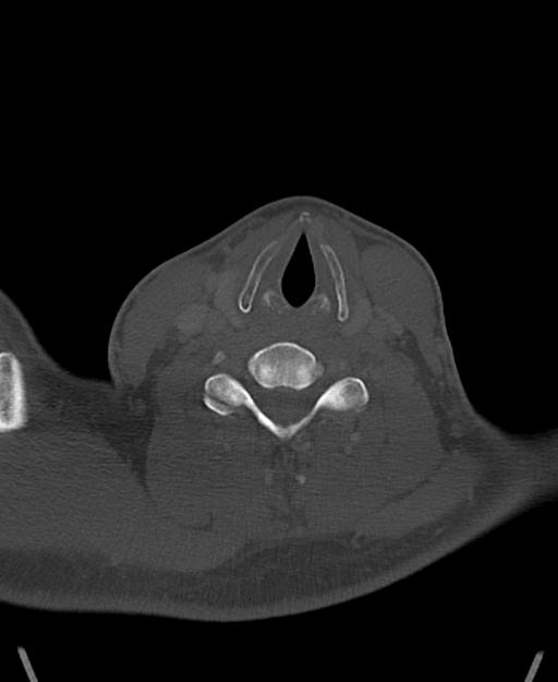 Branchial cleft cyst (Radiopaedia 31167-31875 Axial bone window 49).jpg