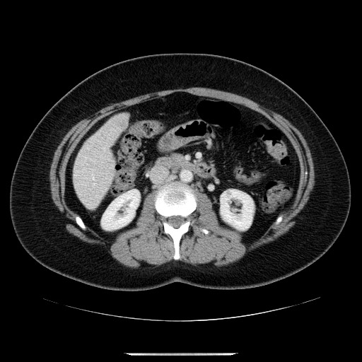 File:Breast cancer pseudocirrhosis after chemotherapy (Radiopaedia 65407-74456 A 42).jpg
