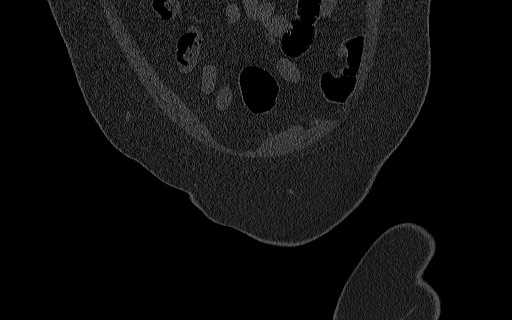 Breast carcinoma with pathological hip fracture (Radiopaedia 60314-67993 Coronal bone window 33).jpg