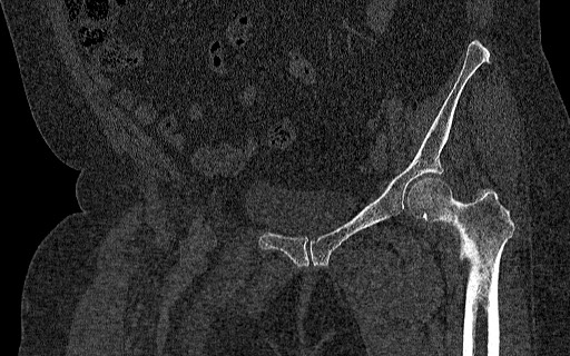 Breast carcinoma with pathological hip fracture (Radiopaedia 60314-67993 Coronal bone window 58).jpg