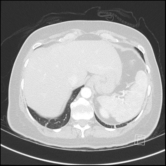 File:Breast metastases from renal cell cancer (Radiopaedia 79220-92225 Axial lung window 76).jpg