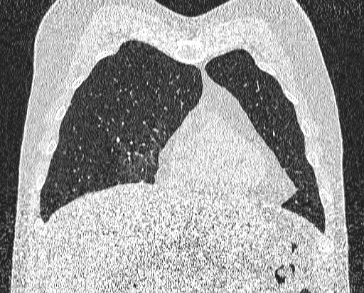 Bronchial atresia (Radiopaedia 58271-65417 Coronal lung window 12).jpg