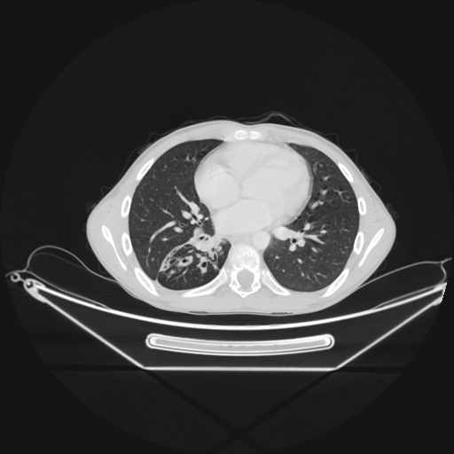 Bronchial carcinoid tumor (Radiopaedia 57187-64090 Axial lung window 50).jpg