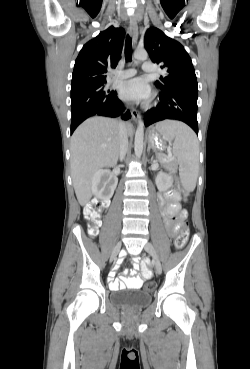 Bronchial carcinoid tumor (Radiopaedia 57187-64090 B 56).jpg