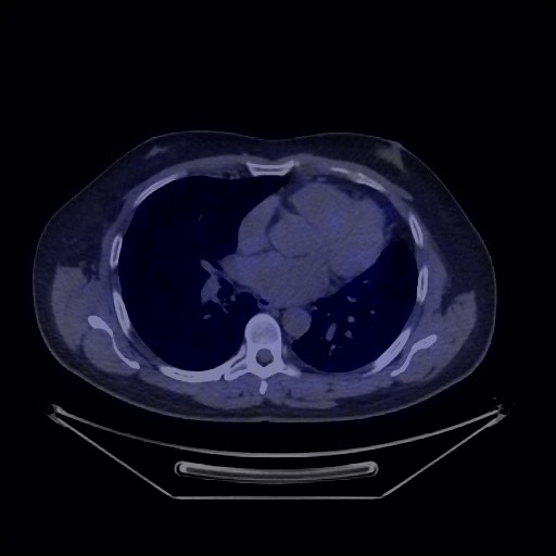 Bronchial carcinoid tumor (Radiopaedia 67377-76765 68Ga-DOTATATE PET-CT 33).jpg
