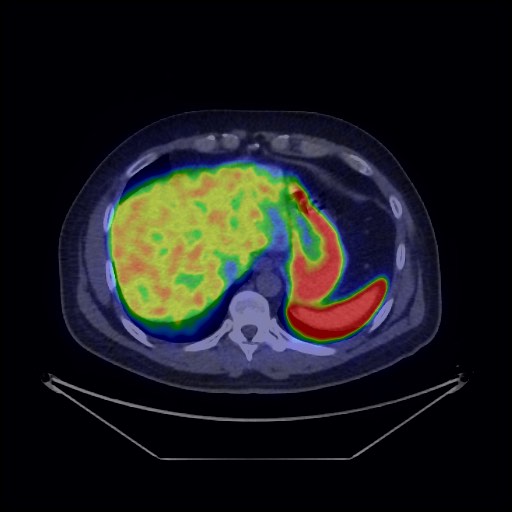 Bronchial carcinoid tumor (Radiopaedia 67377-76765 68Ga-DOTATATE PET-CT 38).jpg