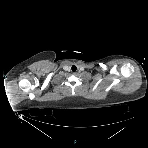 File:Bronchial carcinoid tumor (Radiopaedia 78272-90870 C 9).jpg