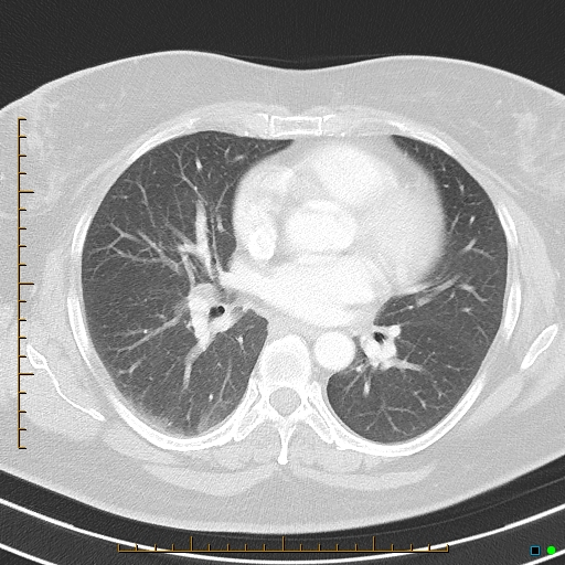 Bronchial diverticula (Radiopaedia 79512-92675 Axial lung window 26).jpg