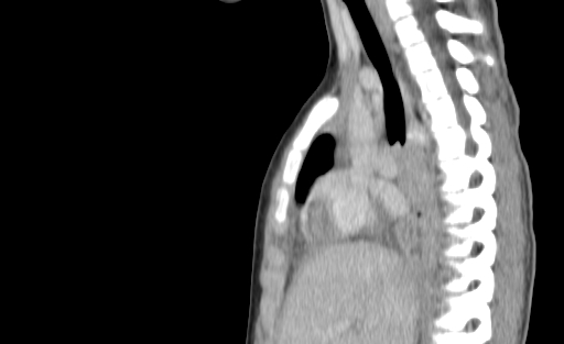 Bronchial mucoepidermoid carcinoma (Radiopaedia 57023-63895 Sagittal 99).jpg