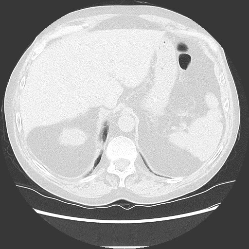 Bronchial stenosis - lung transplant (Radiopaedia 73133-83848 Axial lung window 56).jpg