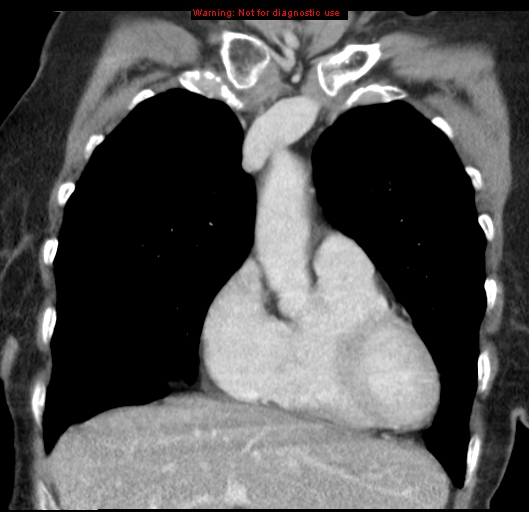 Bronchoalveolar carcinoma (BAC) (Radiopaedia 13436-13392 E 17).jpg