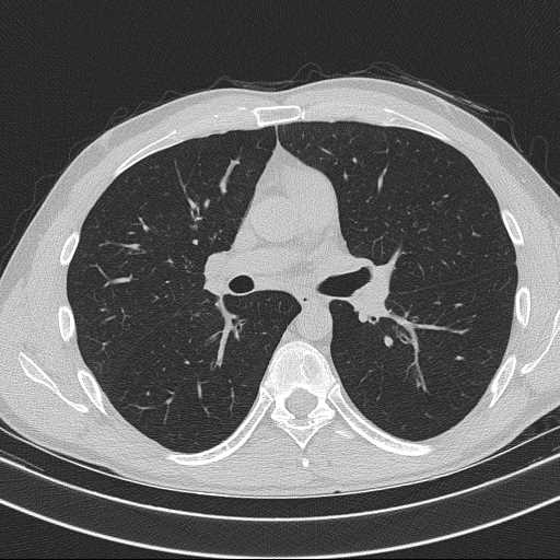 File:Bronchocele (Radiopaedia 60676-68429 Axial lung window 33).jpg