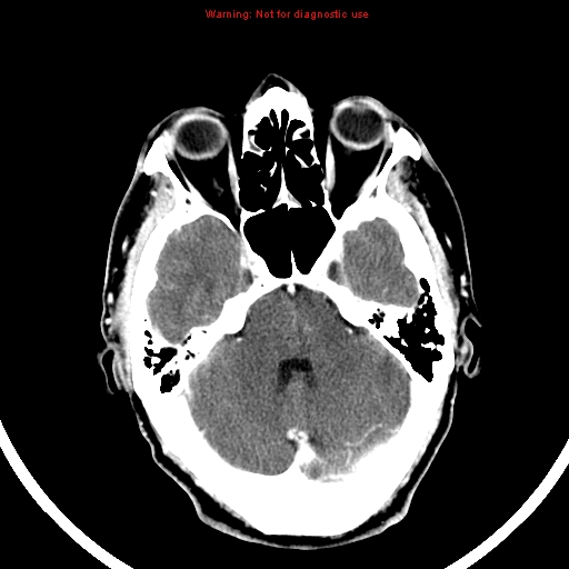 File:Bronchogenic carcinoma brain metastasis (Radiopaedia 9286-9970 B 8).jpg