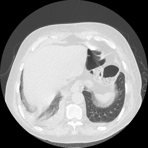 Bronchogenic carcinoma with metastatic lymphadenopathy (Radiopaedia 37671-39569 Axial lung window 46).jpg