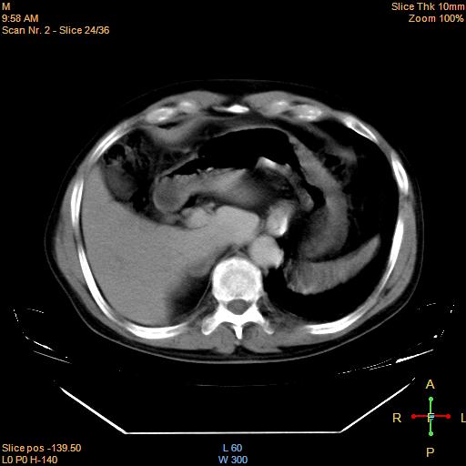 File:Bronchogenic carcinoma with superior vena caval invasion (Radiopaedia 22378-22406 Axial liver window 21).jpg