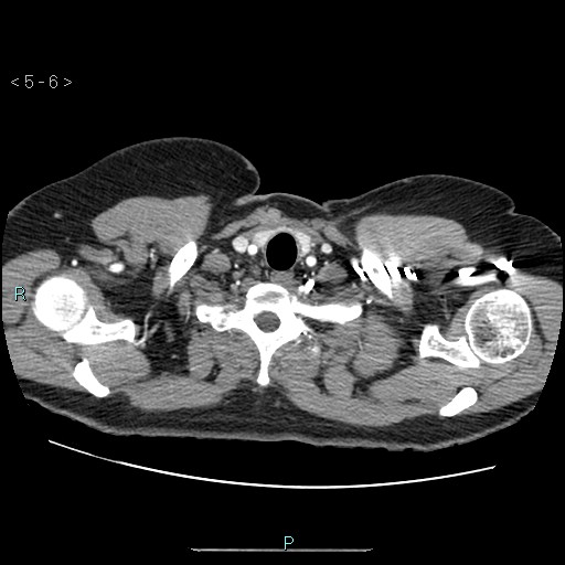 Bronchogenic cyst - posterior mediastinal (Radiopaedia 43885-47364 A 3).jpg