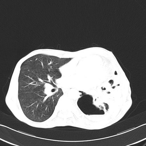 Bronchopleural fistula secondary to tuberculosis (Radiopaedia 20415-20322 Axial lung window 33).jpg