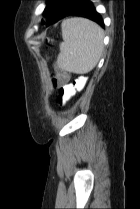 Brown tumors compressing the spinal cord (Radiopaedia 68442-77988 F 49).jpg