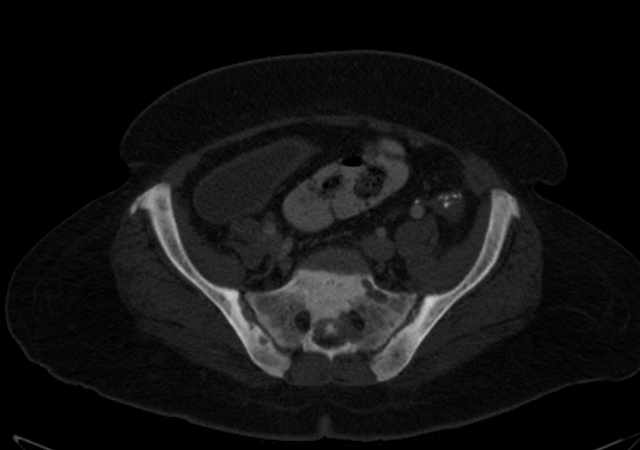 Brown tumors compressing the spinal cord (Radiopaedia 68442-77988 G 96).jpg