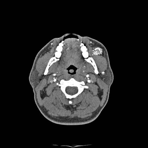Buccal fat pad arteriovenous malformation (Radiopaedia 70936-81144 D 185).jpg