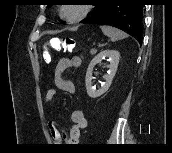 Buried bumper syndrome - gastrostomy tube (Radiopaedia 63843-72577 Sagittal Inject 30).jpg