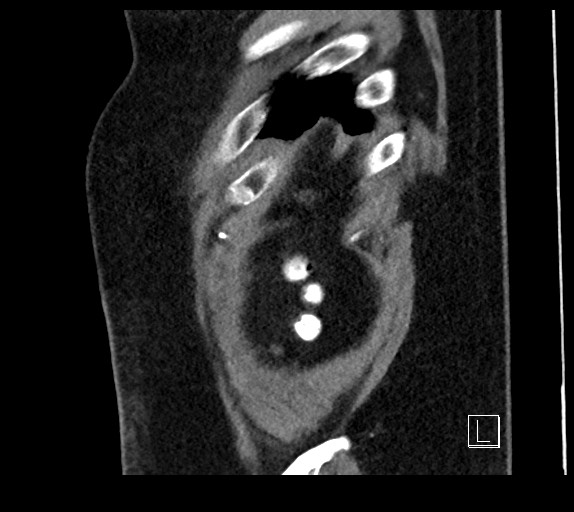 Buried bumper syndrome - gastrostomy tube (Radiopaedia 63843-72577 Sagittal Inject 8).jpg