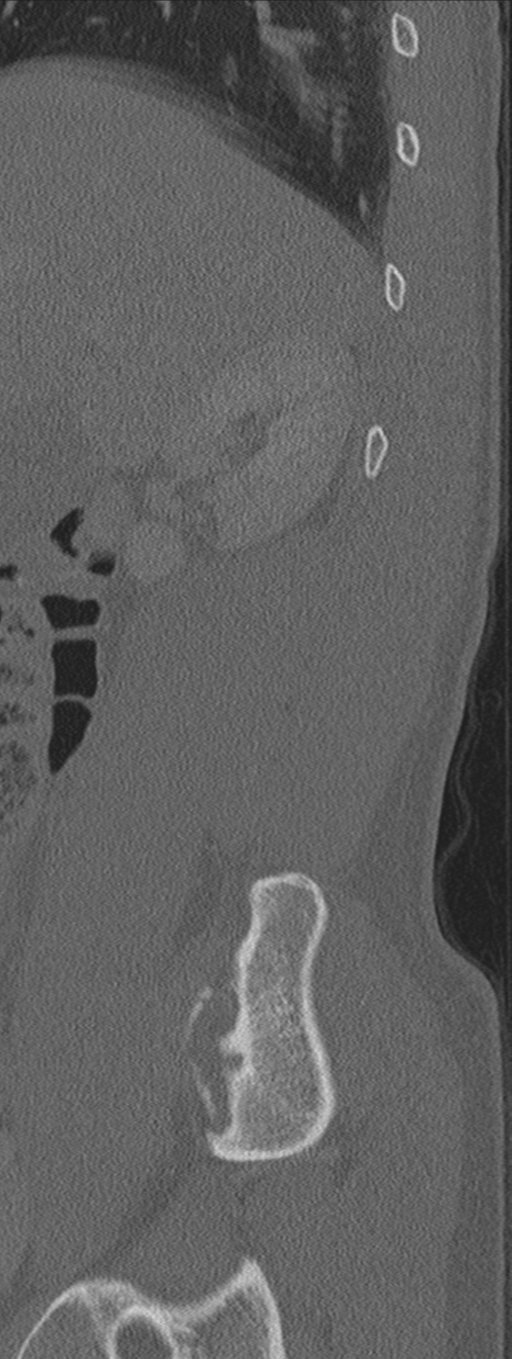 Burst fracture - T12 with conus compression (Radiopaedia 56825-63647 Sagittal bone window 80).png