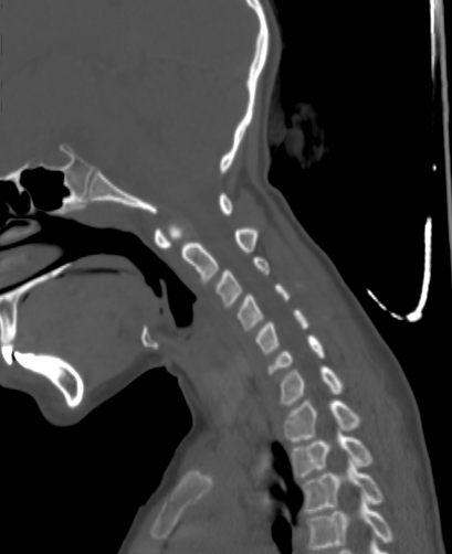 File:Butterfly vertebra (Radiopaedia 77903-90209 Sagittal bone window 35).jpg