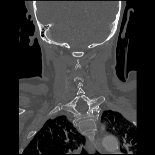 File:C1 anterior arch (plough) fracture - type 1 (Radiopaedia 76181-87720 Coronal bone window 32).jpg