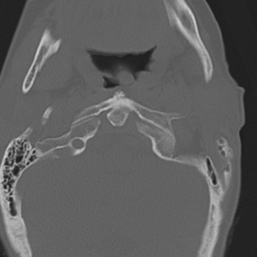 File:C2 fracture with vertebral artery dissection (Radiopaedia 37378-39199 Axial bone window 10).png