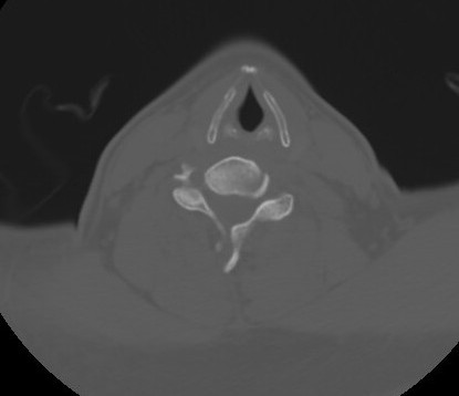 File:C7 laminar fracture and Klippel-Feil syndrome (Radiopaedia 86710-102850 Axial bone window 49).jpg