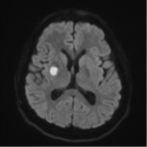 File:CNS vasculitis (Radiopaedia 55715-62263 Axial DWI 45).png