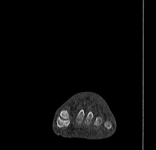Calcaneal fracture - Sanders type 4 (Radiopaedia 90179-107370 Coronal bone window 23).jpg