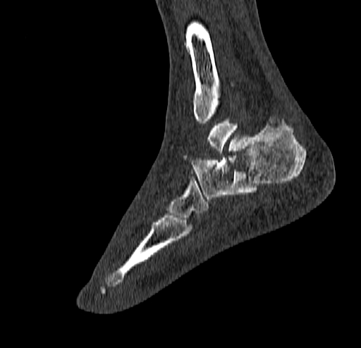 Calcaneal fracture - Sanders type 4 (Radiopaedia 90179-107370 Sagittal bone window 64).jpg