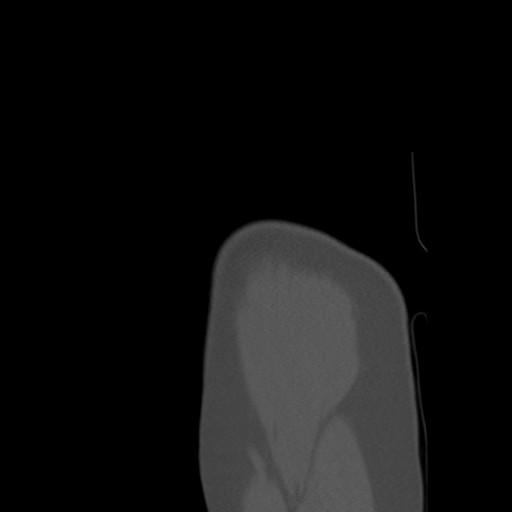 File:Calcific tendinitis of the infraspinatus tendon (Radiopaedia 87256-103539 Sagittal bone window 10).jpg