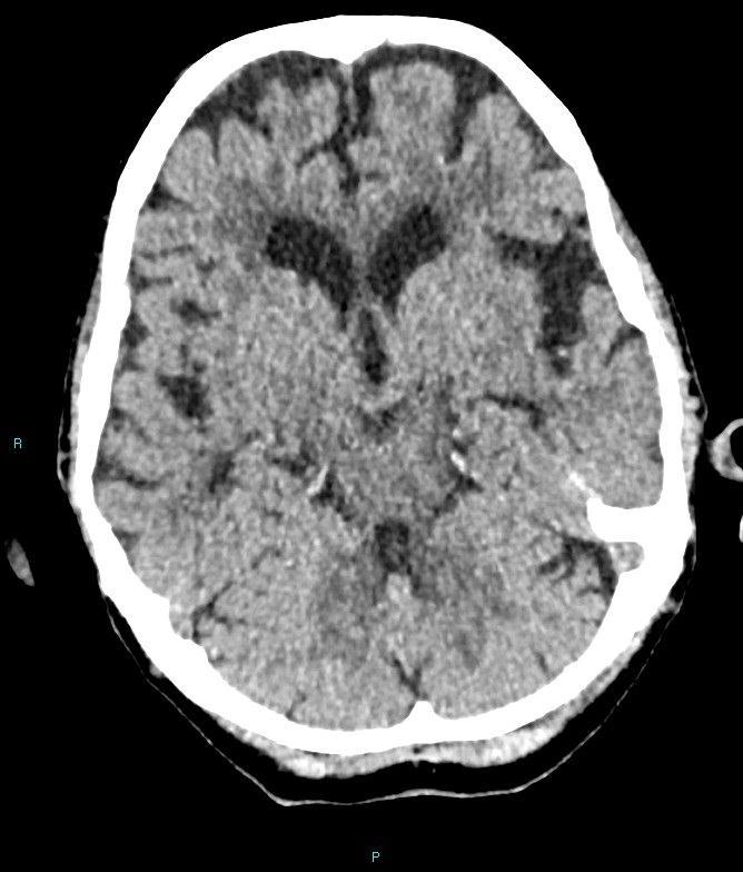 Calcified cerebral emboli from left ventricular thrombus (Radiopaedia 84420-99758 Axial non-contrast 61).jpg