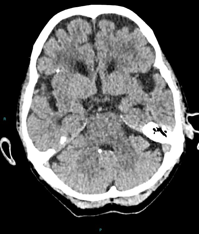 Calcified cerebral emboli from left ventricular thrombus (Radiopaedia 84420-99758 Axial non-contrast 64).jpg